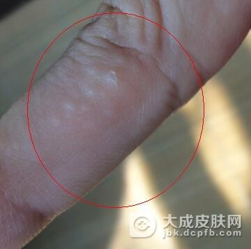 痒点怎么治疗