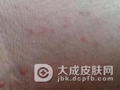 自身免疫性孕酮性皮炎的症状有哪些