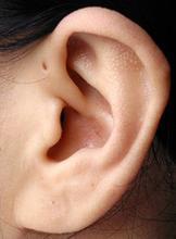 遗传性耳瘘如何预防