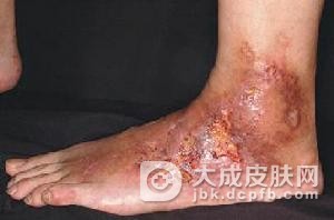 雅司病是怎么引起的