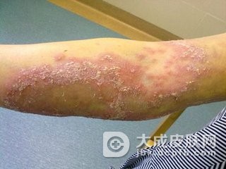 哪些是脓疱型牛皮癣的病因