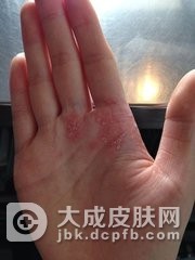 脓疱型银屑病症状到底是什么