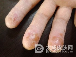 脓疱型银屑病有哪些特征