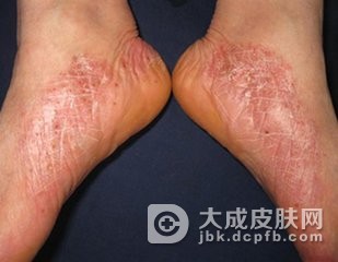 日常生活中脓疱型银屑病患者要怎么护理呢-