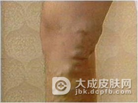 特发性皮肤钙化病的症状有哪些