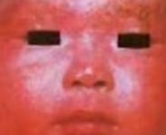 小儿面部红斑侏儒综合征是怎么引起的