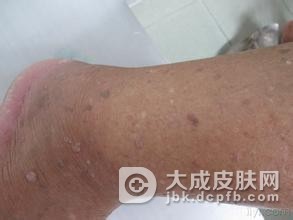 疣状肢端角化病病因及症状