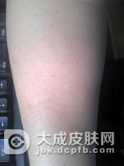 专家解答：毛囊角化症是否传染