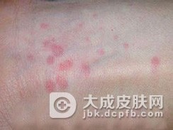 妊娠瘙痒性荨麻疹性丘疹及斑块病的症状