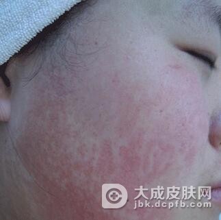 持久性色素异常性红斑怎么办