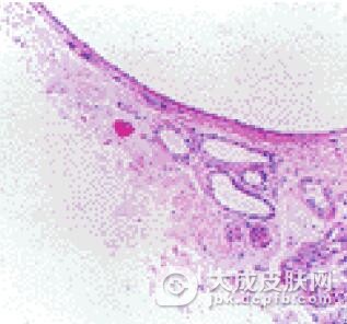 怎样治疗小汗腺汗囊肿