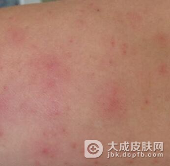 皮肤出现中毒性红斑怎么办