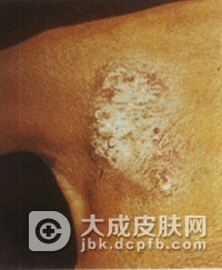 如何预防疣状皮肤结核
