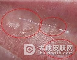多毛状小阴唇的治疗方法有哪些