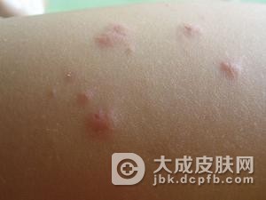 丘疹坏死性结核疹的概述是什么