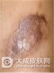 硬皮病产生的原因