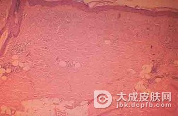 硬皮病的类型特点