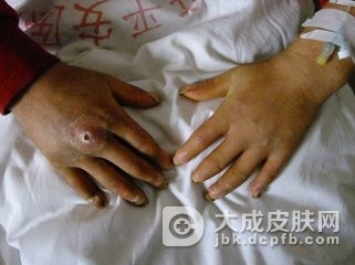 得了硬皮病该怎么办呢
