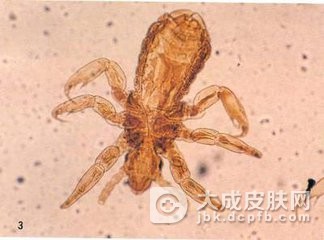 阴虱病的常见传染途径