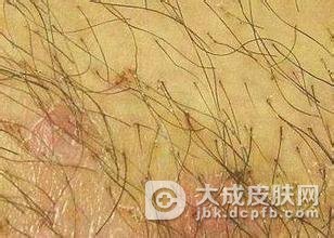 阴虱病主要病因