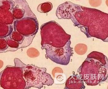 组织细胞吞噬性脂膜炎容易与哪些疾病混淆