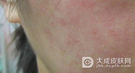 去除自敏性皮炎的病因