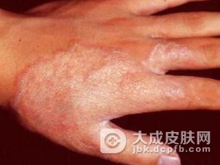 自身敏感性皮炎的特点