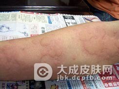 全析家族性血管性水肿