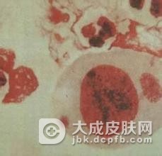 妊娠合并沙眼衣原体感染的症状以及治疗方法
