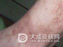 念珠状红苔藓的病因及鉴别诊断