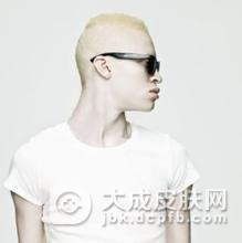 白化病是隔代传吗