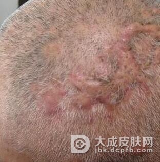 怎样预防穿凿脓肿性头部毛囊炎及毛囊周围炎