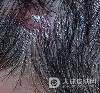 治疗穿凿脓肿性头部毛囊炎及毛囊周围炎方法