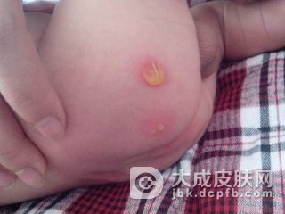 黄水疮可由其他皮肤疾病引发