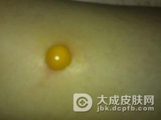 儿童黄水疮会引发的疾病