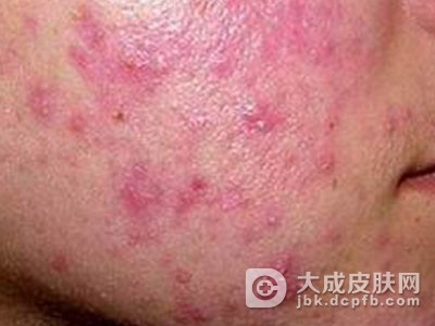 恙螨皮炎的症状有哪些