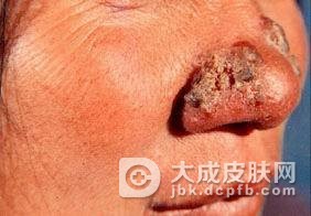 皮肤念珠菌病的主要的表现是什么