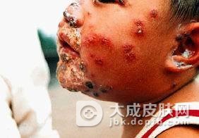 慢性黏膜皮肤念珠菌病要如何诊断
