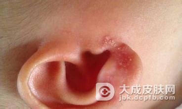 外耳湿疹的发病特点有哪些