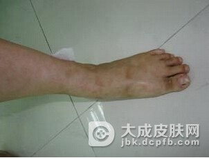 颜面部疖痈的治疗措施都有什么
