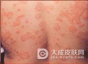 血清病性荨麻疹的病因是什么