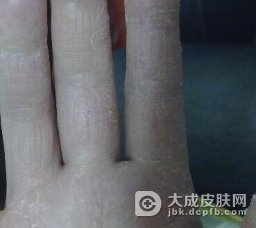 患上了水疥怎么护理