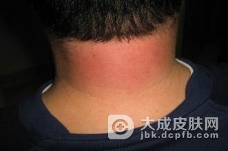 新生儿硬肿症什么表现呢