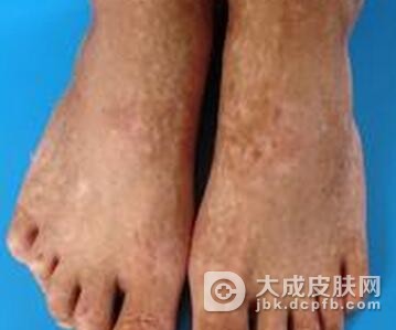 遗传性对称性色素异常症如何治疗