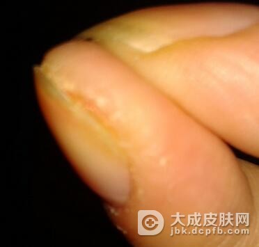 如何预防脓性指头炎