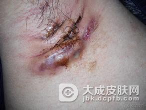 化脓性汗腺炎是什么症状呢