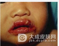 儿童维生素A缺乏如何预防