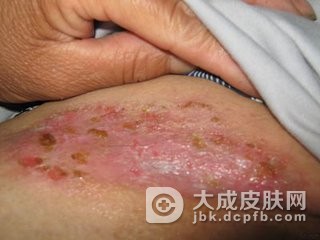 皮肤念珠菌病应该怎样治疗