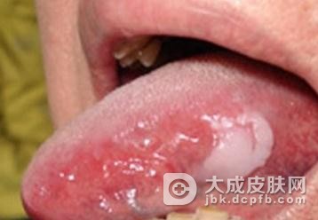 粘膜白斑要与哪些疾病鉴别