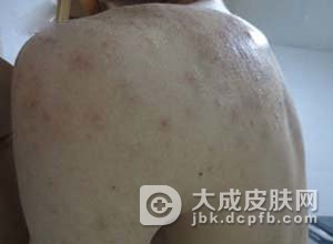 马拉色菌病如何鉴别诊断